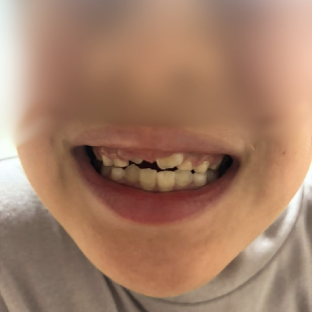 床矯正を始める前の長男の前歯