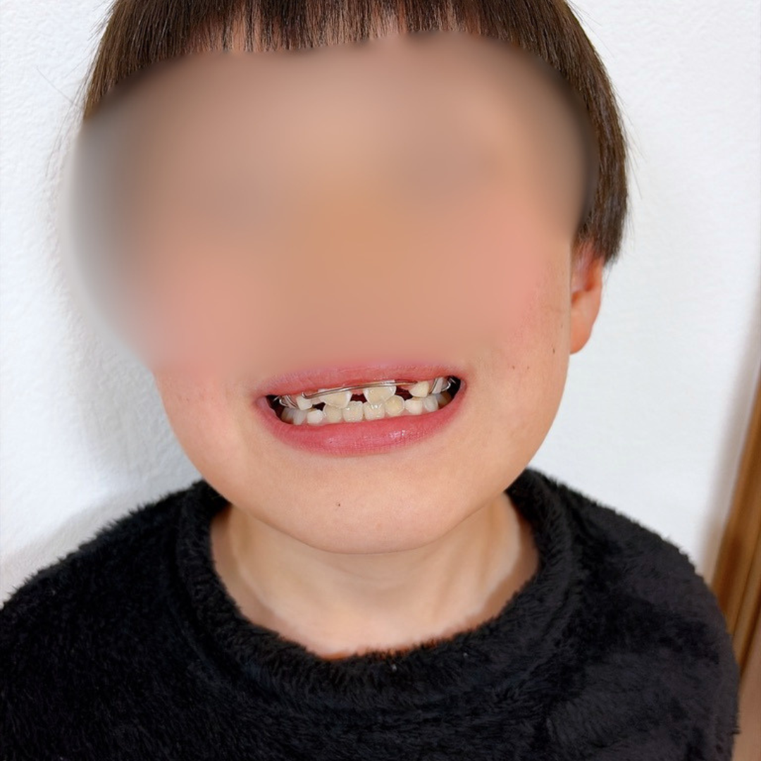 床矯正を始めた頃の長男の歯並び